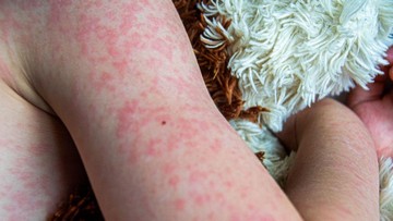 Kemenkes Rilis Data Lonjakan Kasus Campak: Belasan Provinsi Tetapkan Status KLB