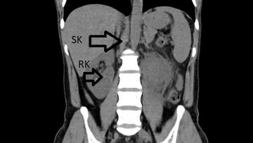 Keajaiban Medis di India: Pria Muda Berjuang Lawan ISK Parah, Dokter Temukan Organ Ketiga Tak Terduga